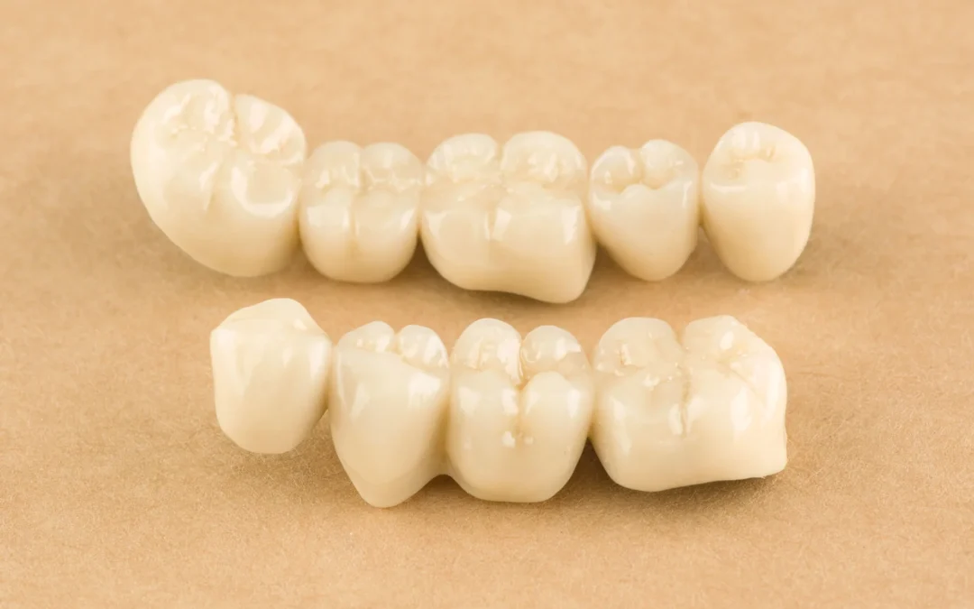 The Benefits of Replacing Missing Teeth Early