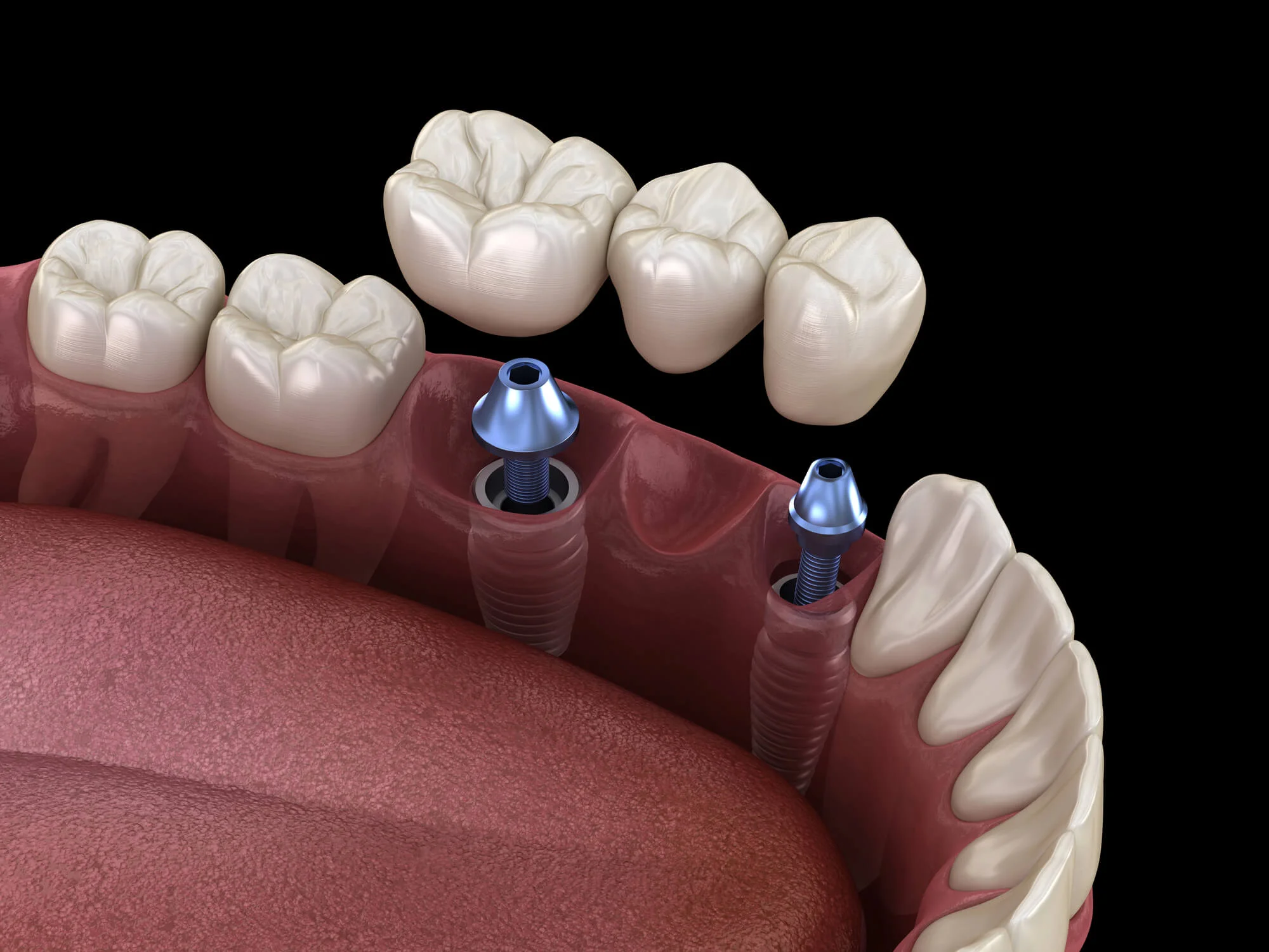 Dental-crowns-in-Kennett-Square-implant-restoration