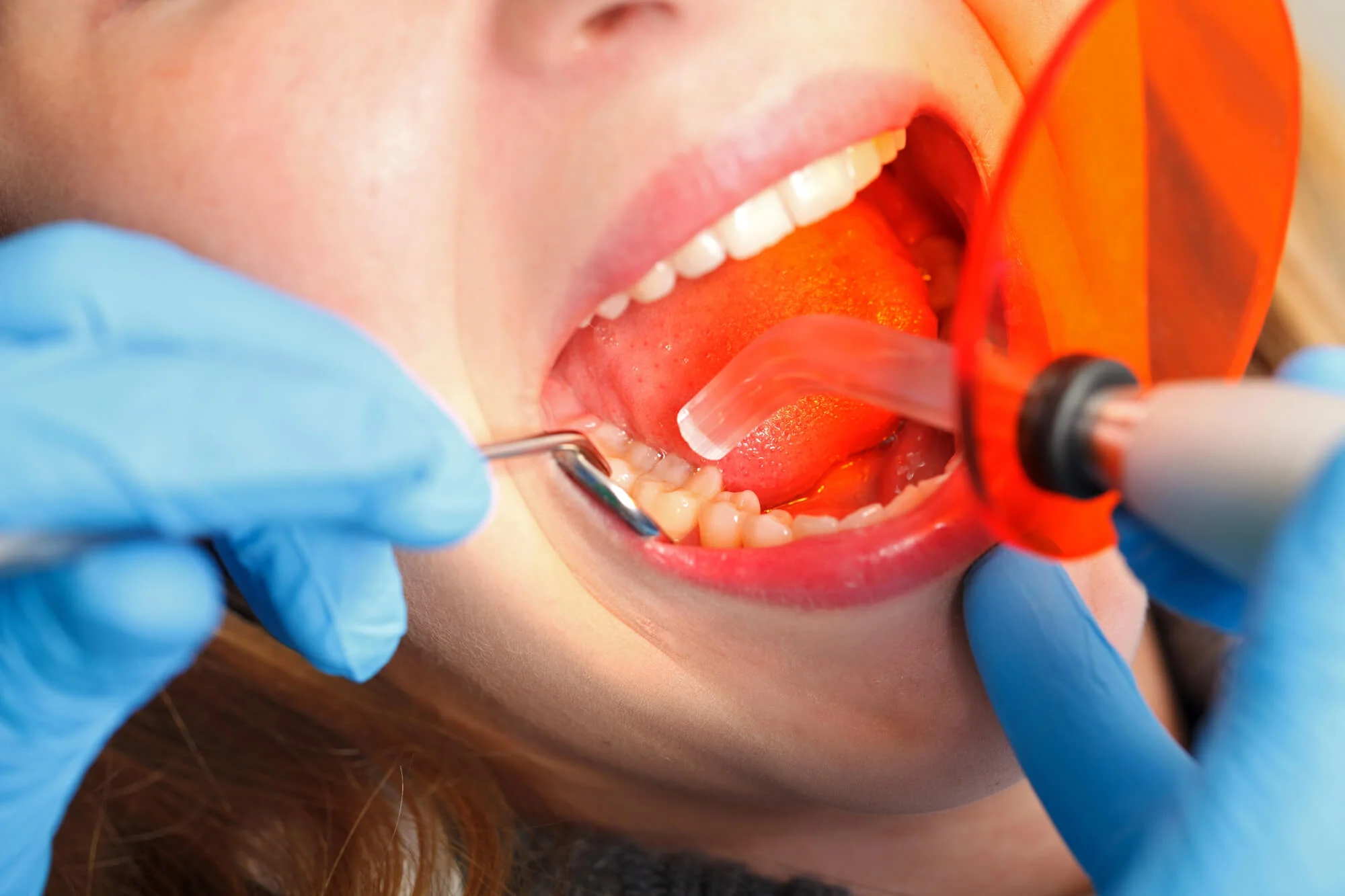 Dental curing light used during tooth procedure with tools Murphy Dental