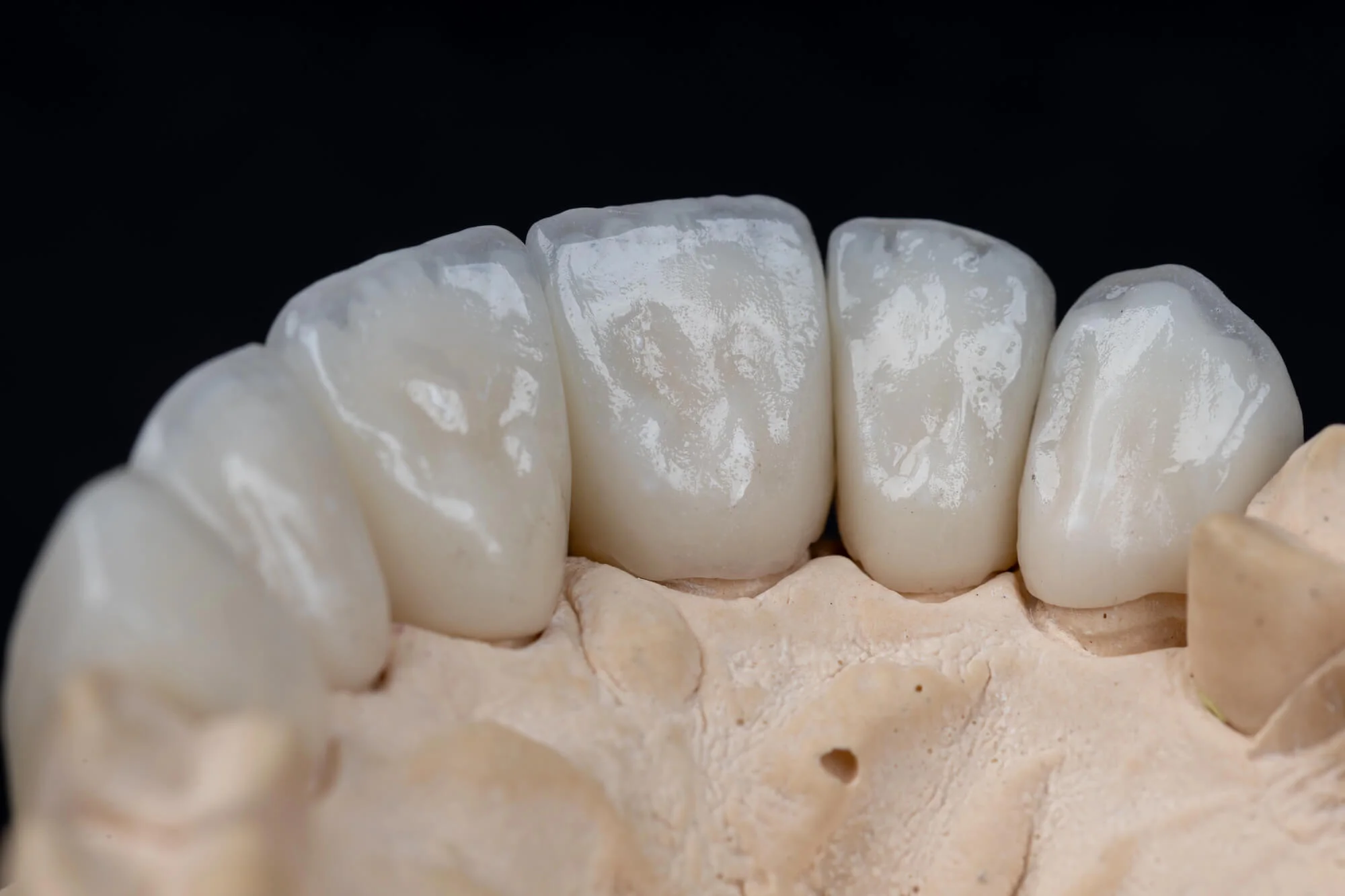 Natural-looking-dental-crowns-in-Kennett-Square