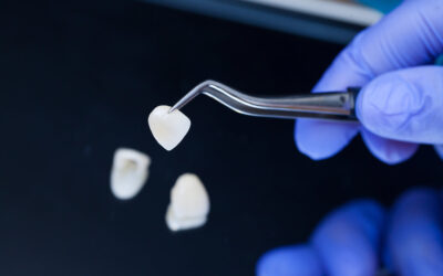 How Do You Know If You Need a Crown or a Veneer?