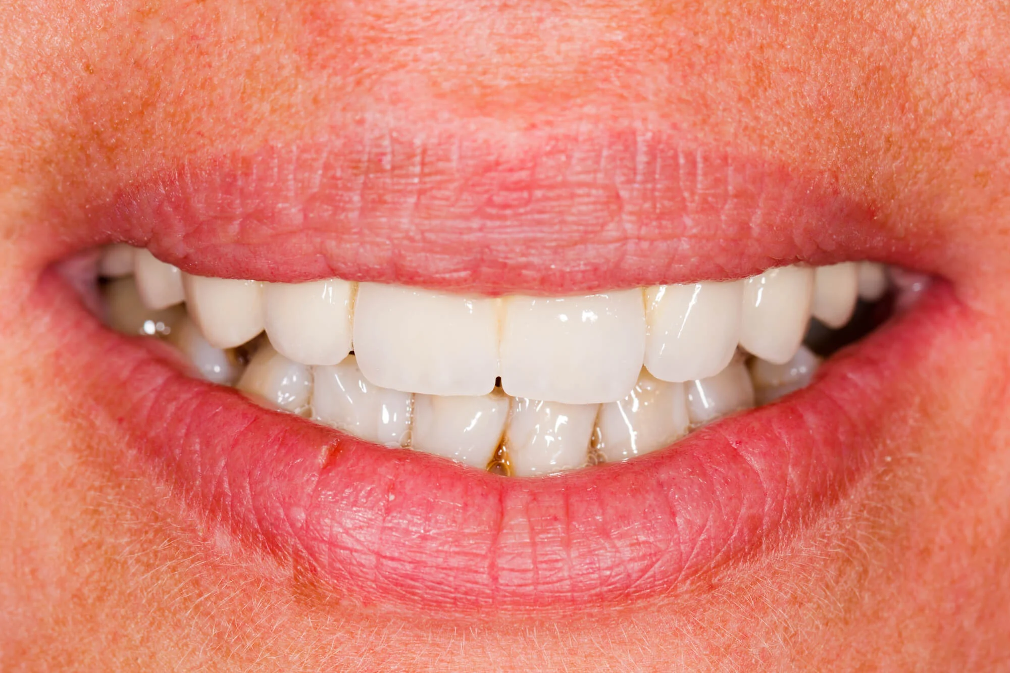 Restored smile – dental bridges in Kennett Square