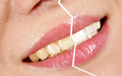 Is Teeth Whitening Right for You? Key Factors Guide