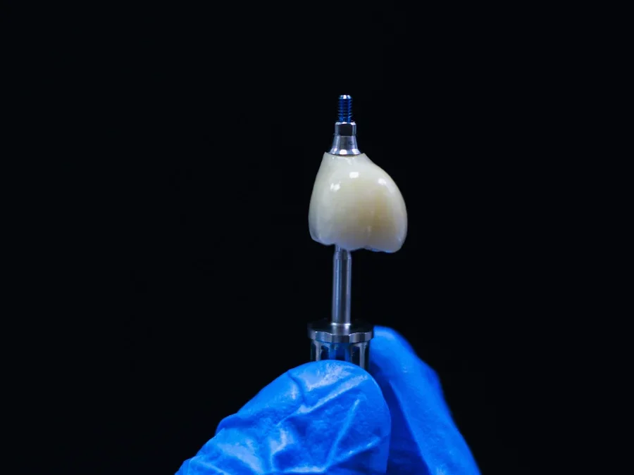 Why Patients Choose Dental Implants Over Dentures Locally