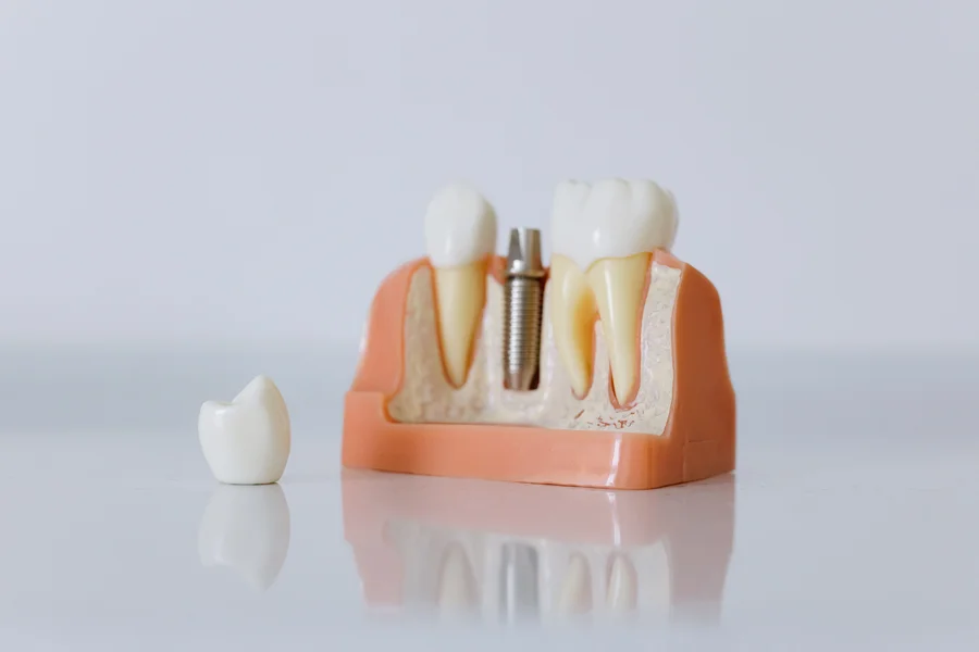 dental implants kennett square cross section jaw model