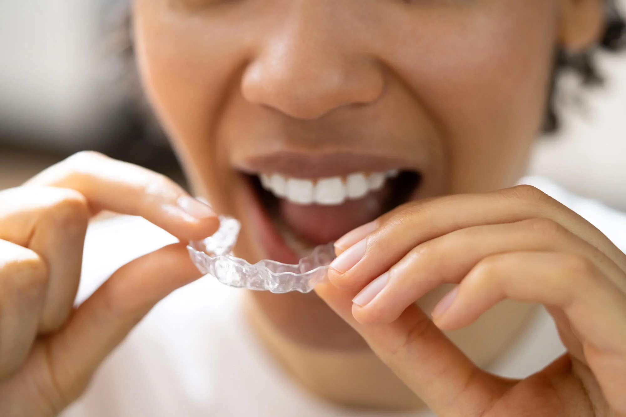 putting on aligners invisalign in Kennett Square